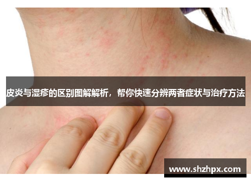 皮炎与湿疹的区别图解解析，帮你快速分辨两者症状与治疗方法
